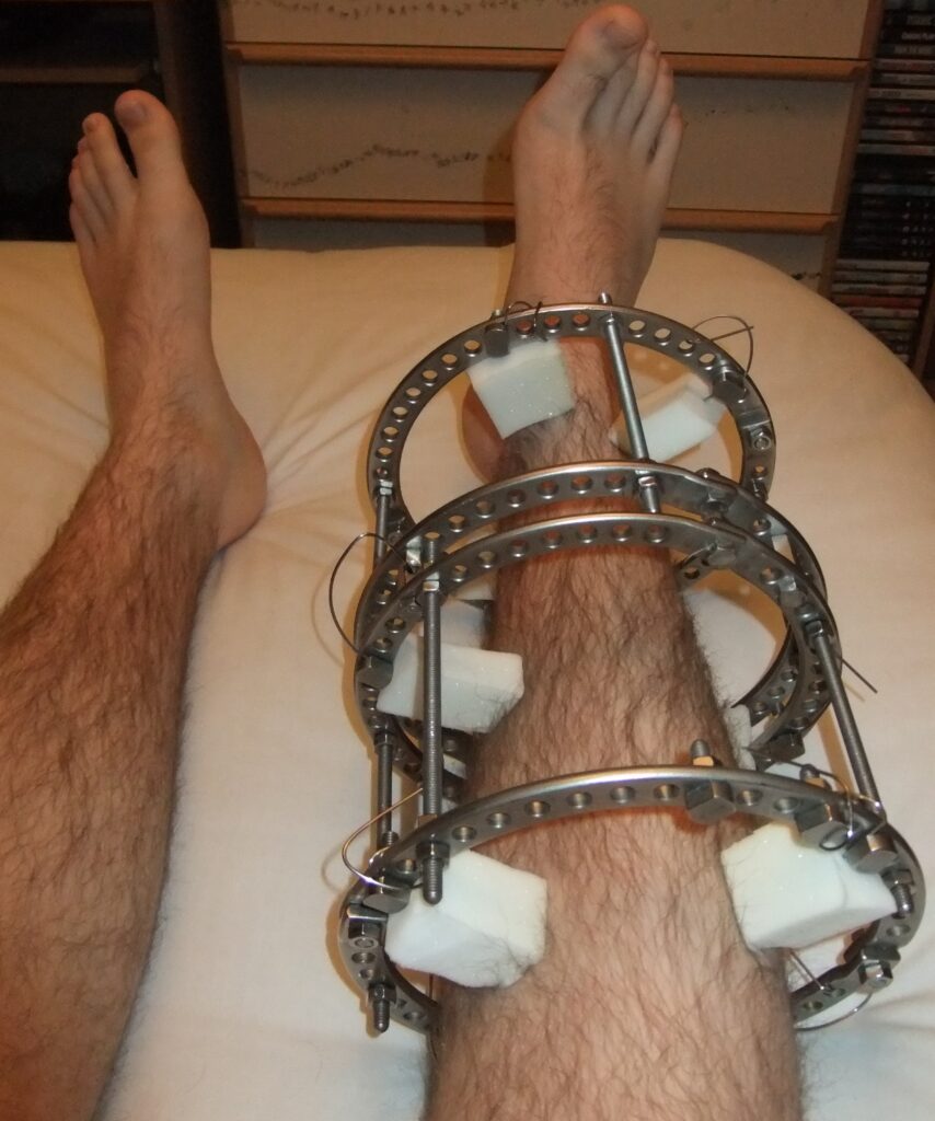 A lower leg held in an Ilizarov circular external fixator frame, resting on a bed